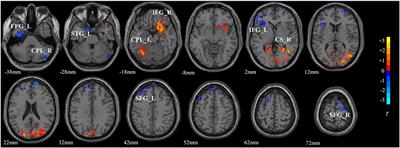 Dopamine Multilocus Genetic Profile, Spontaneous Activity of Left Superior Temporal Gyrus, and Early Therapeutic Effect in Major Depressive Disorder